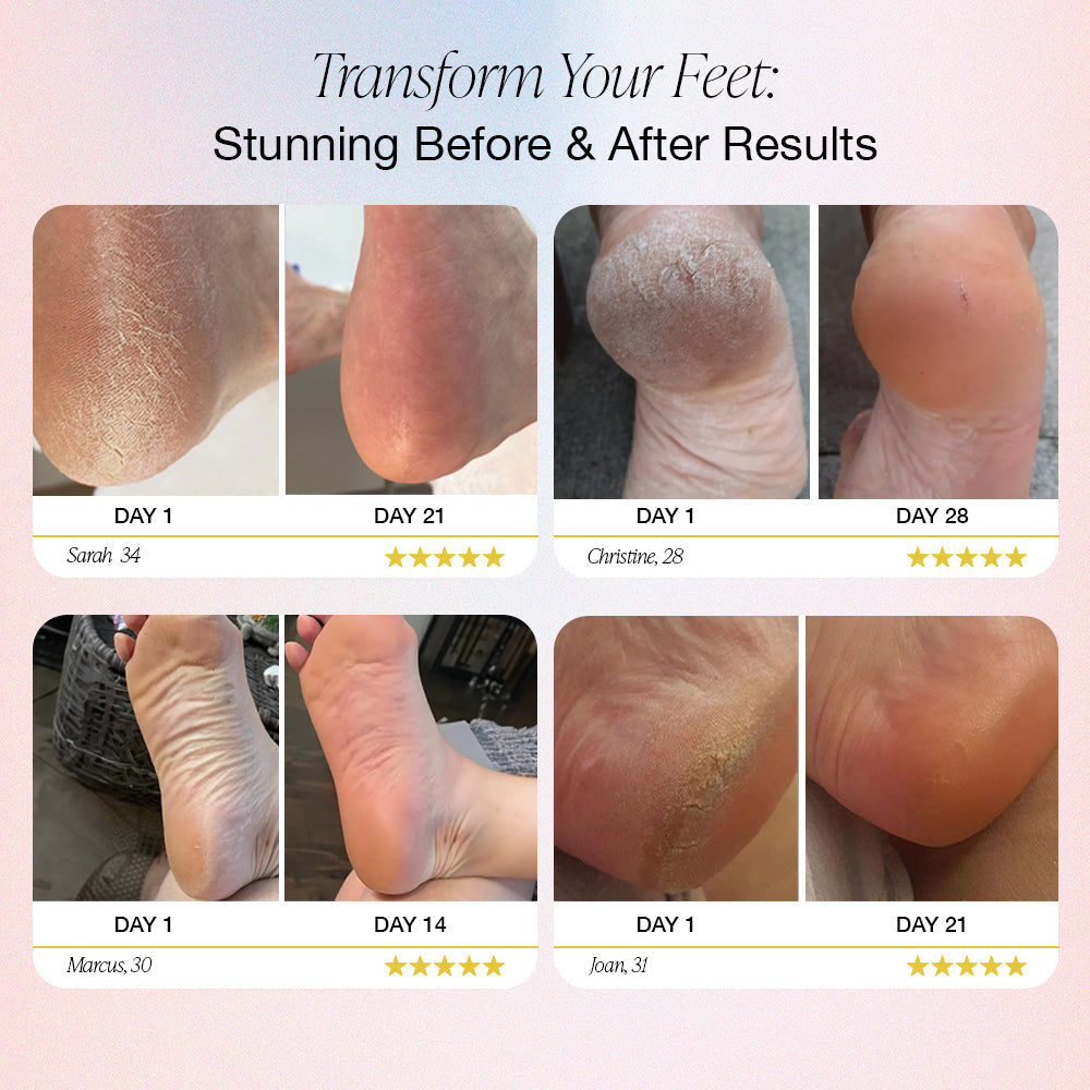 Czucon™ Electric Foot Callus Remover